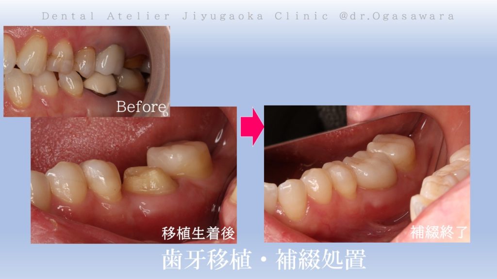 歯牙移植・補綴処置