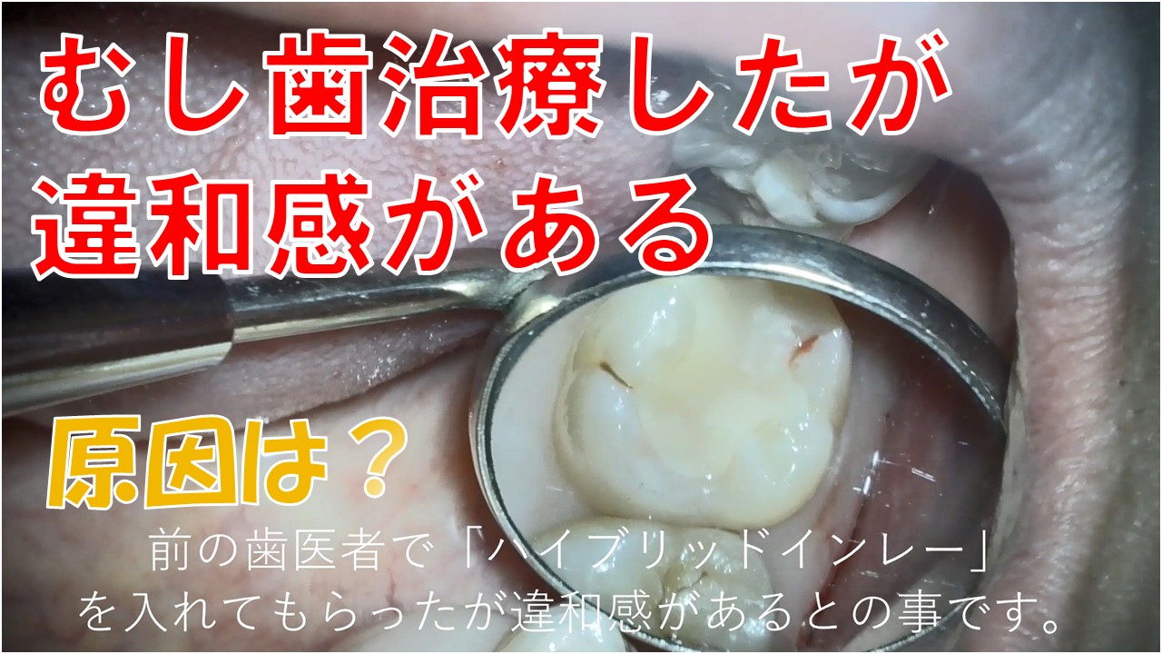 虫歯治療、違和感　セカンドオピニオン