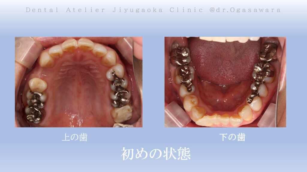 セラミック治療　インプラント　ホワイトニング　自由が丘　歯医者