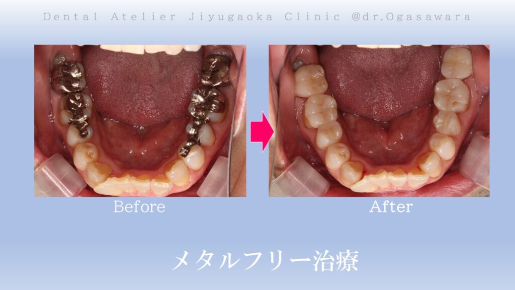 セラミック治療　インプラント　ホワイトニング　自由が丘　歯医者