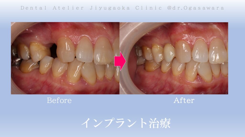 セラミック治療　インプラント　ホワイトニング　自由が丘　歯医者