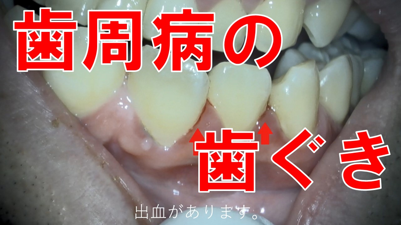 歯周病の歯ぐき