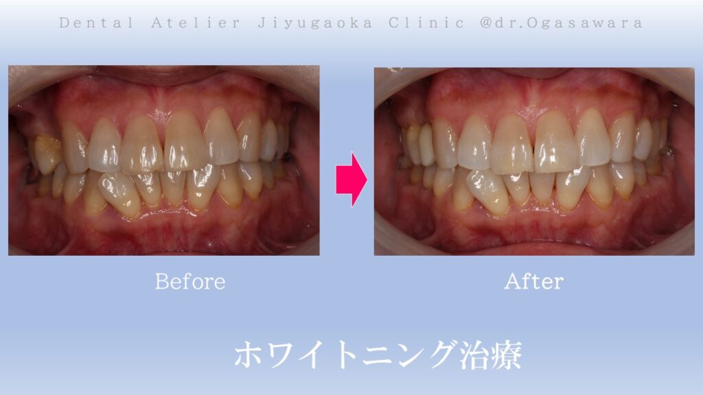 セラミック治療　インプラント　ホワイトニング　自由が丘　歯医者