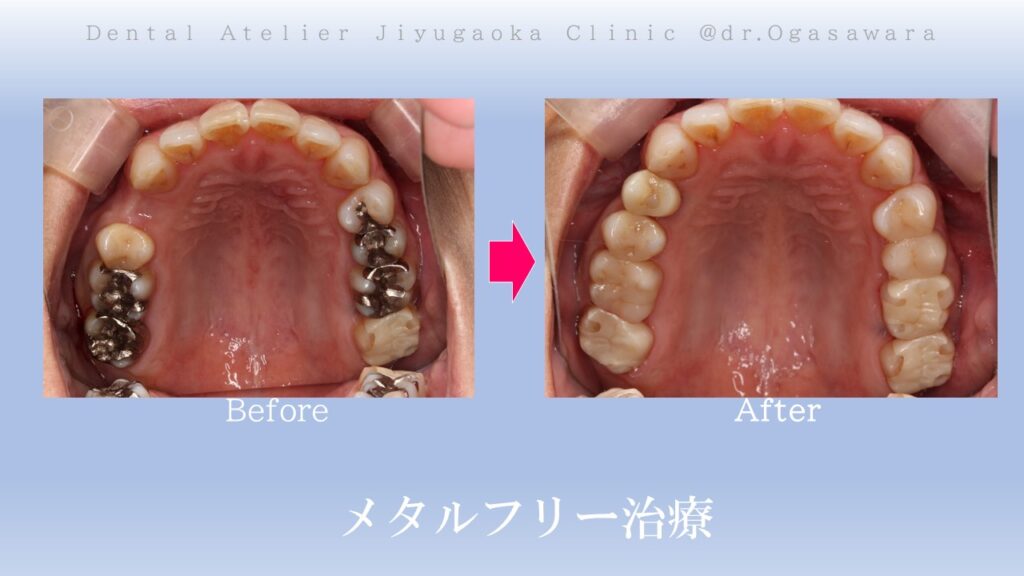 セラミック治療　インプラント　ホワイトニング　自由が丘　歯医者