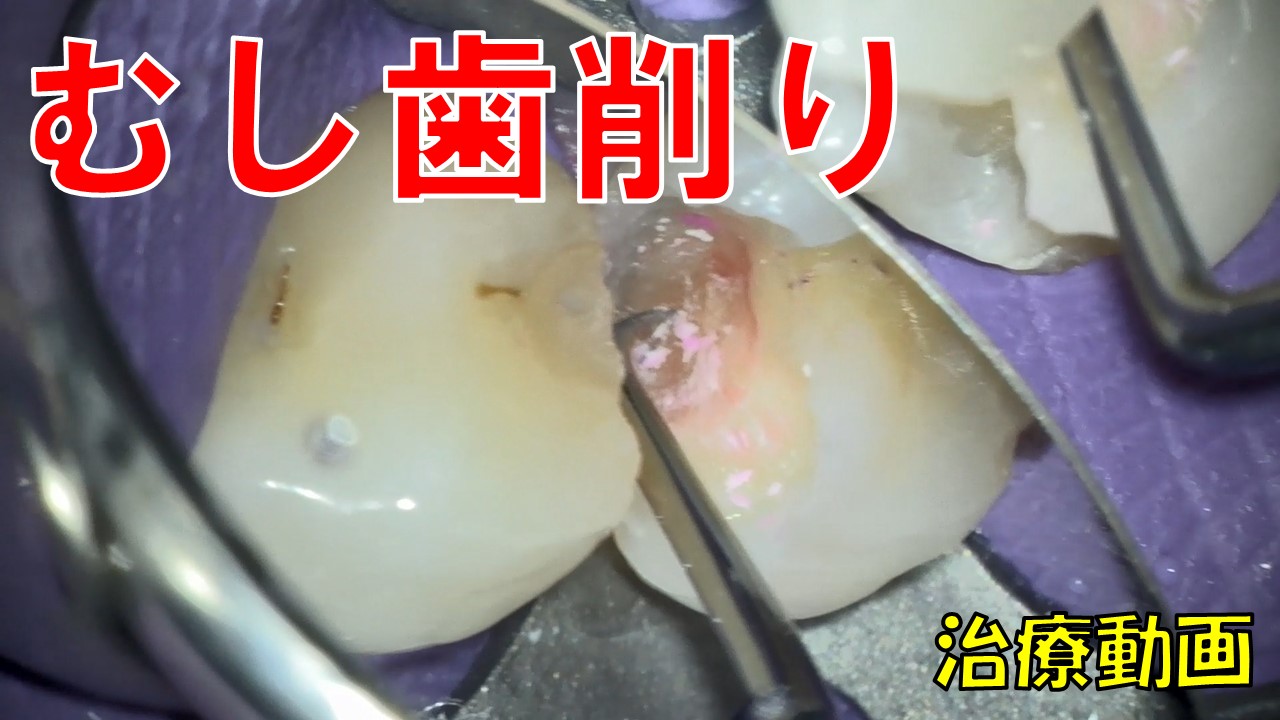 むし歯削り