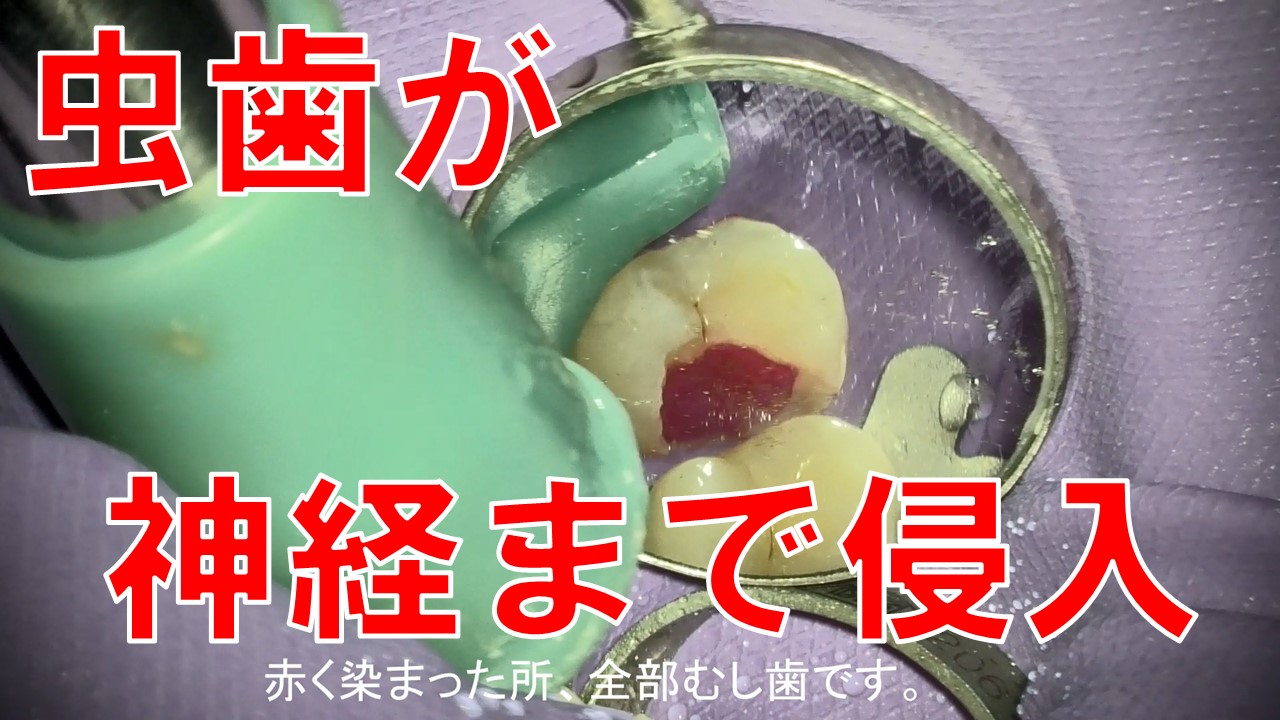 虫歯が神経まで