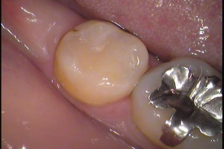 奥歯ダイレクトボンディング