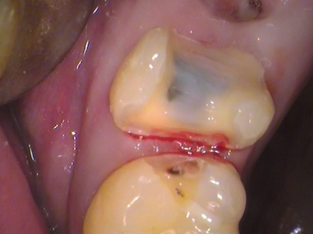 自由が丘　歯医者　奥歯の虫歯