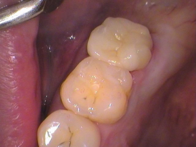 自由が丘　歯医者　セラミック