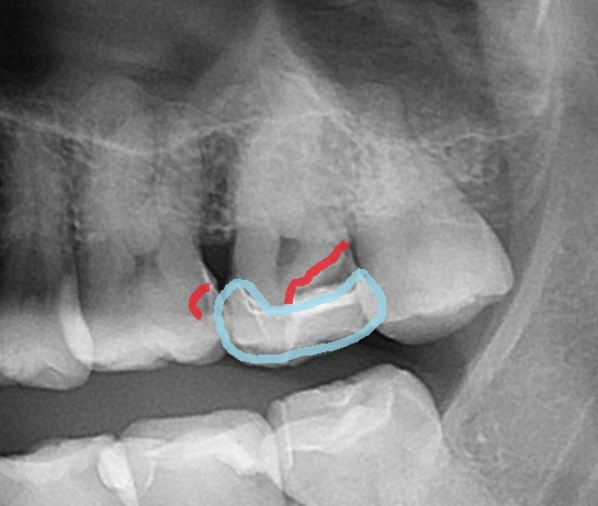 自由が丘　歯医者　レントゲン写真