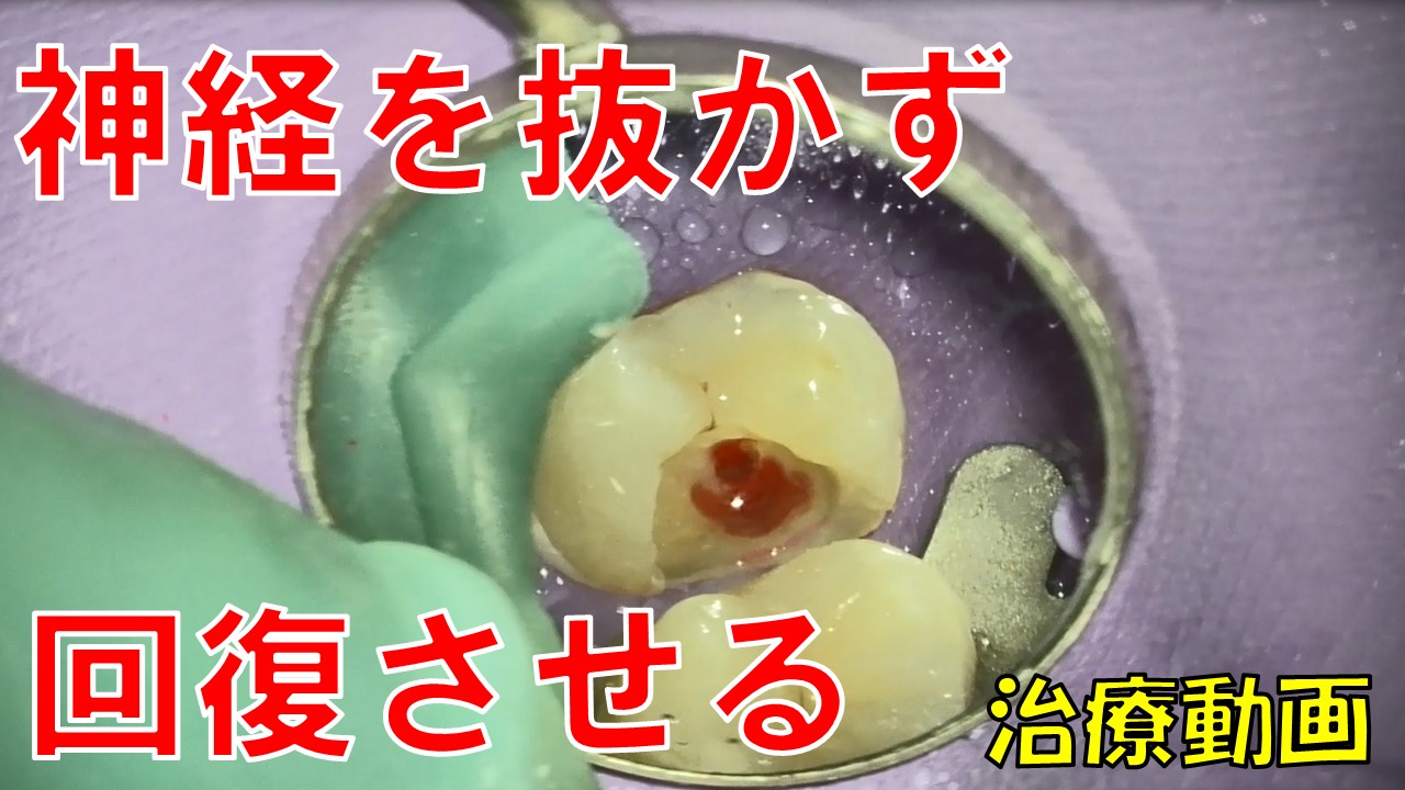 神経保存MTAセメント