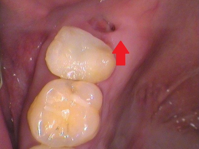 自由が丘　歯医者　奥歯の抜歯