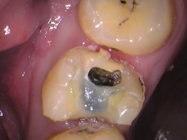 自由が丘　歯医者　奥歯の虫歯