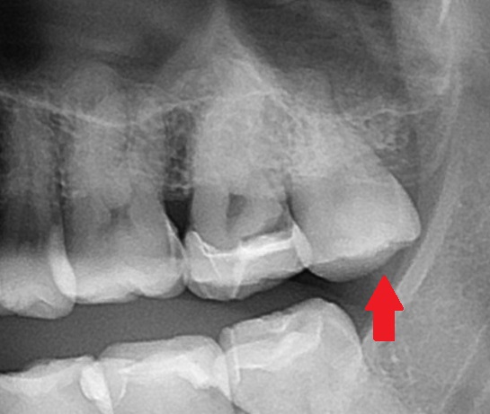 自由が丘　歯医者　レントゲン写真