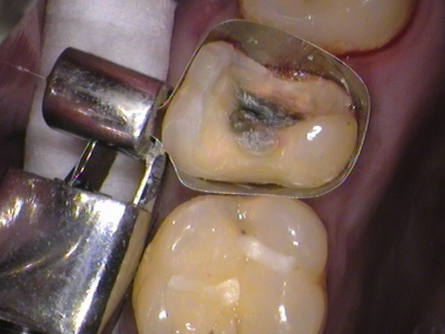 自由が丘　歯医者　奥歯の虫歯