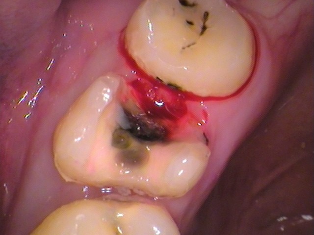 自由が丘　歯医者　奥歯の虫歯