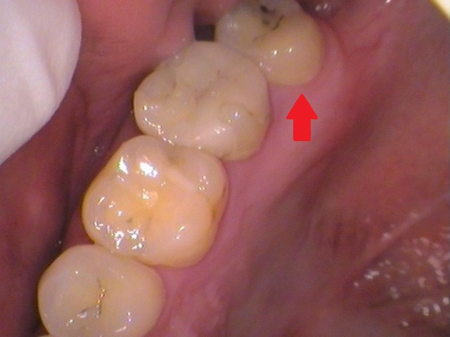 自由が丘　歯医者　奥歯の虫歯