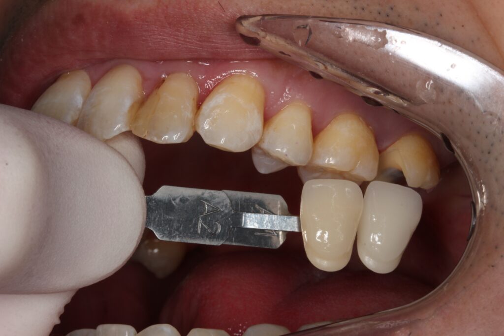 自由が丘　歯医者　セラミック