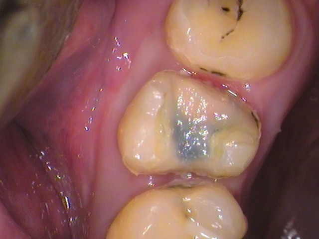 自由が丘　歯医者　奥歯の虫歯