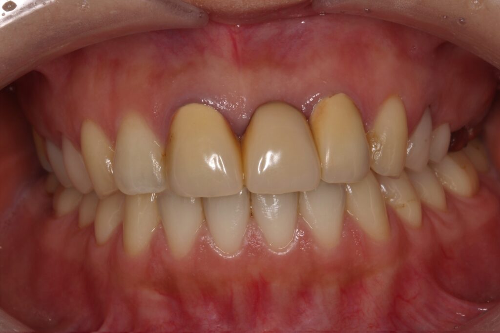 ジルコニア　セラミック　前歯　審美歯科　自由が丘　歯医者