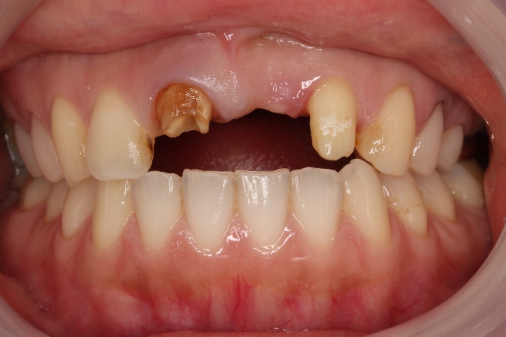 ジルコニア　セラミック　前歯　審美歯科　自由が丘　歯医者