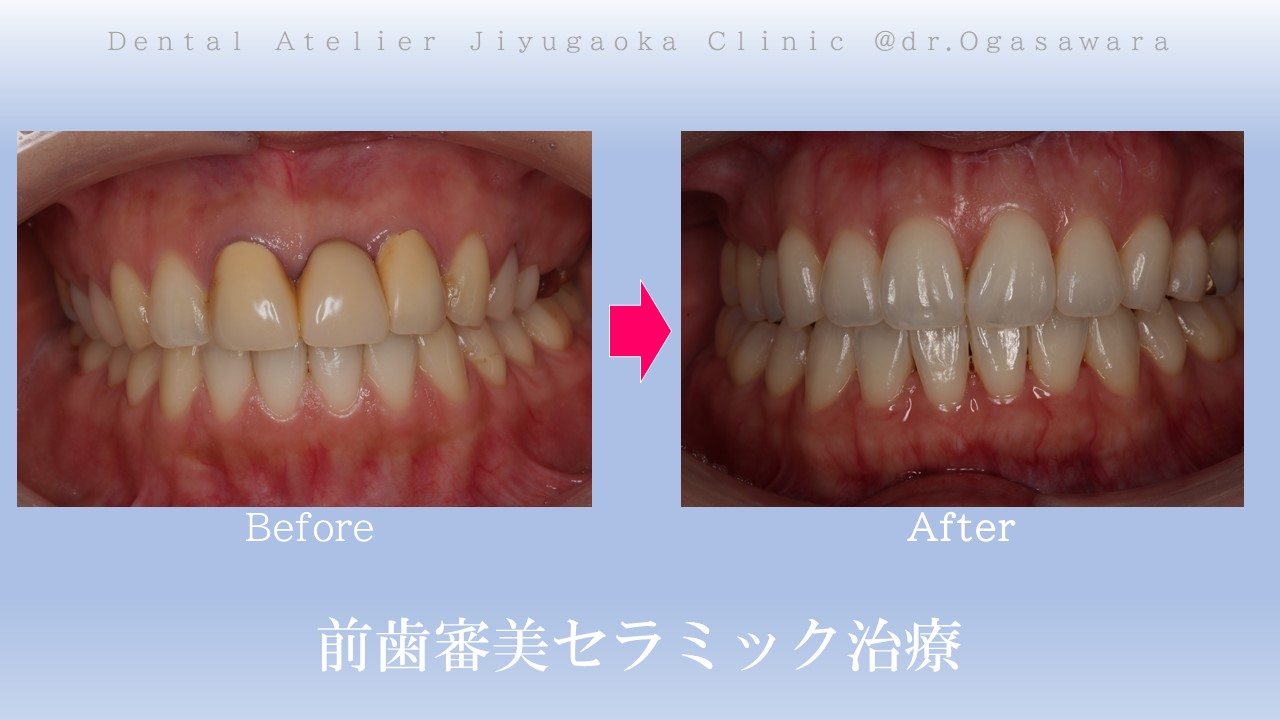 ジルコニア　セラミック　前歯　審美歯科　自由が丘　歯医者