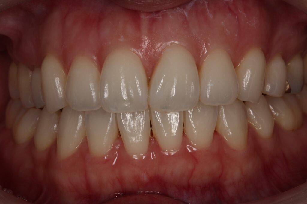 ジルコニア　セラミック　前歯　審美歯科　自由が丘　歯医者