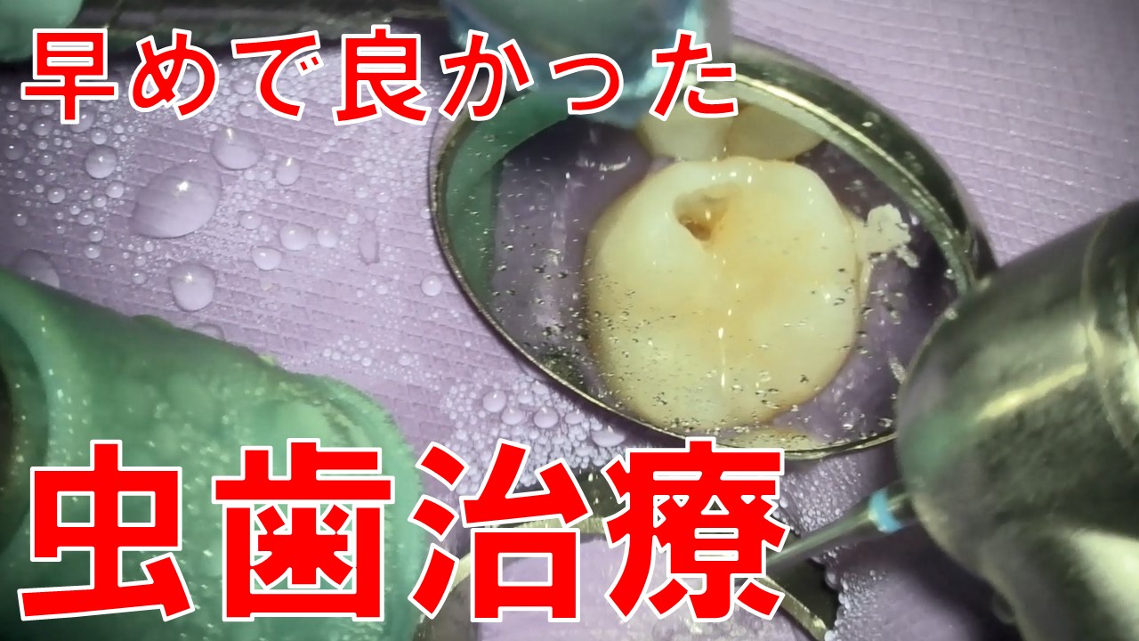虫歯　むし歯治療　動画　早期発見