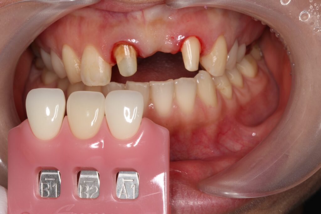 ジルコニア　セラミック　前歯　審美歯科　自由が丘　歯医者