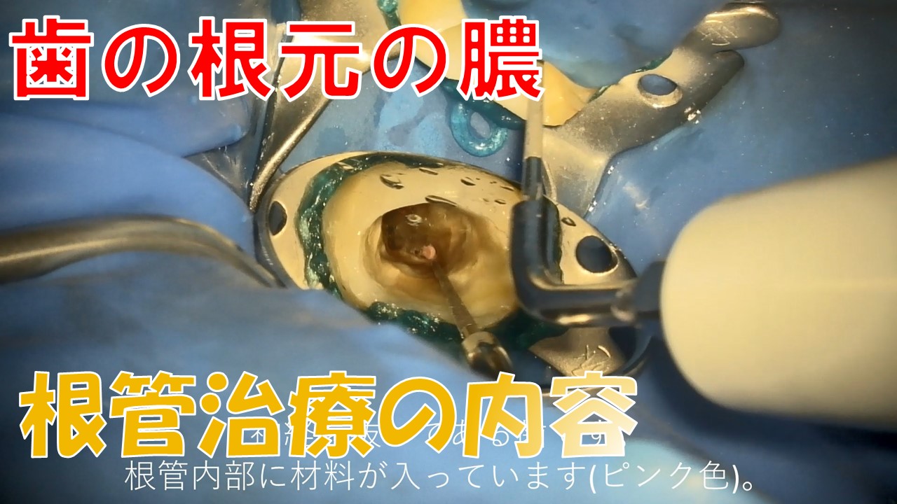 根幹治療　根管治療　動画　セカンドオピニオン