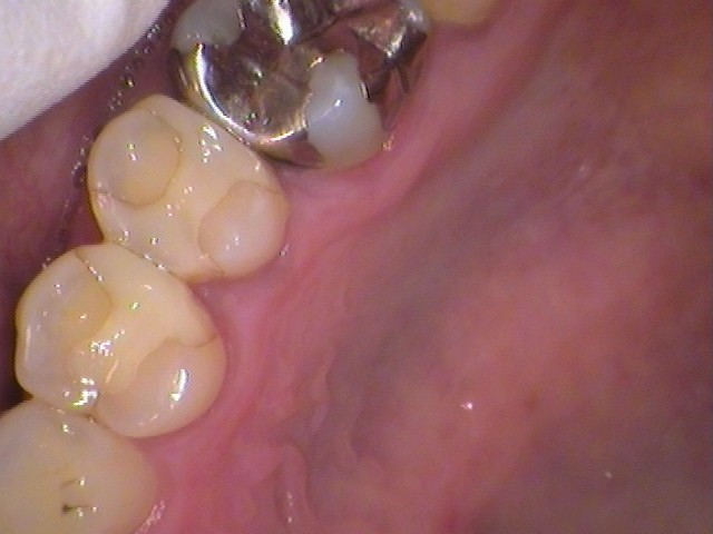 古いハイブリッドインレー