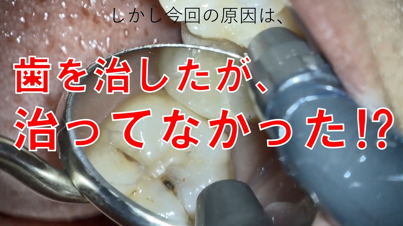 誤切削　セカンドオピニオン　歯科治療ミス
