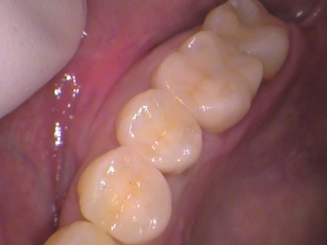 セラミックインレーセット