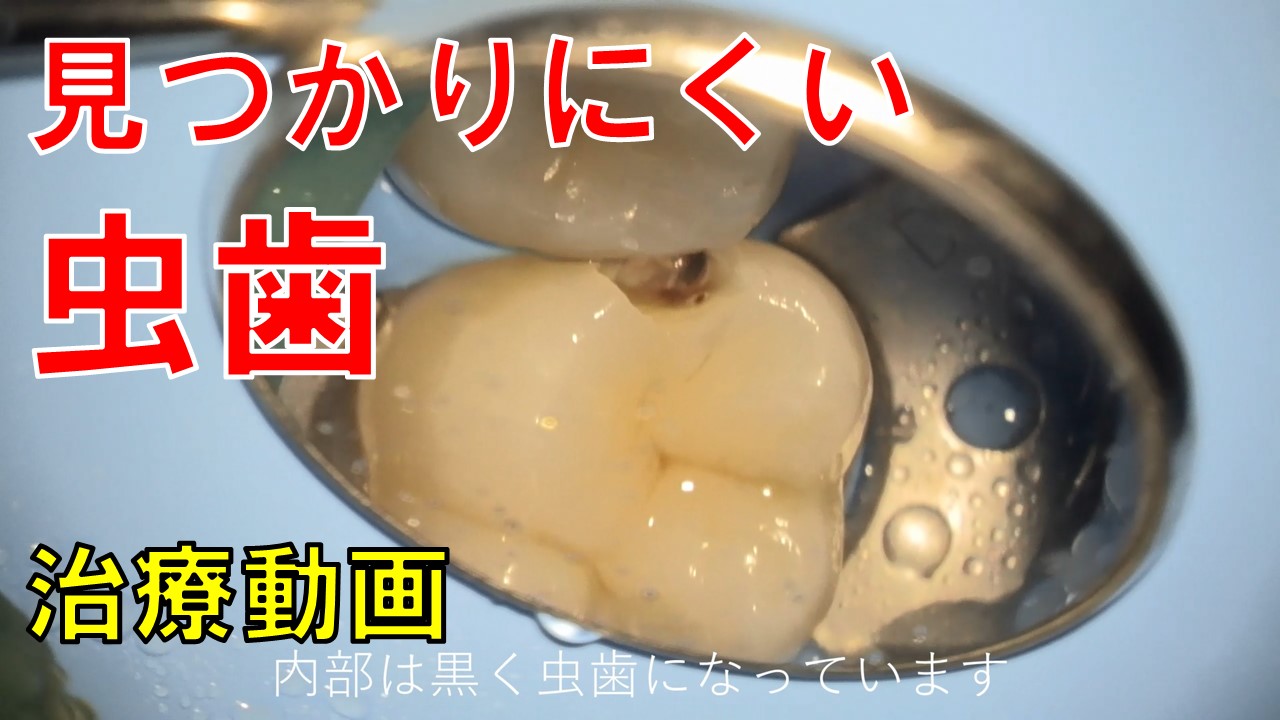 見つかりにくい虫歯