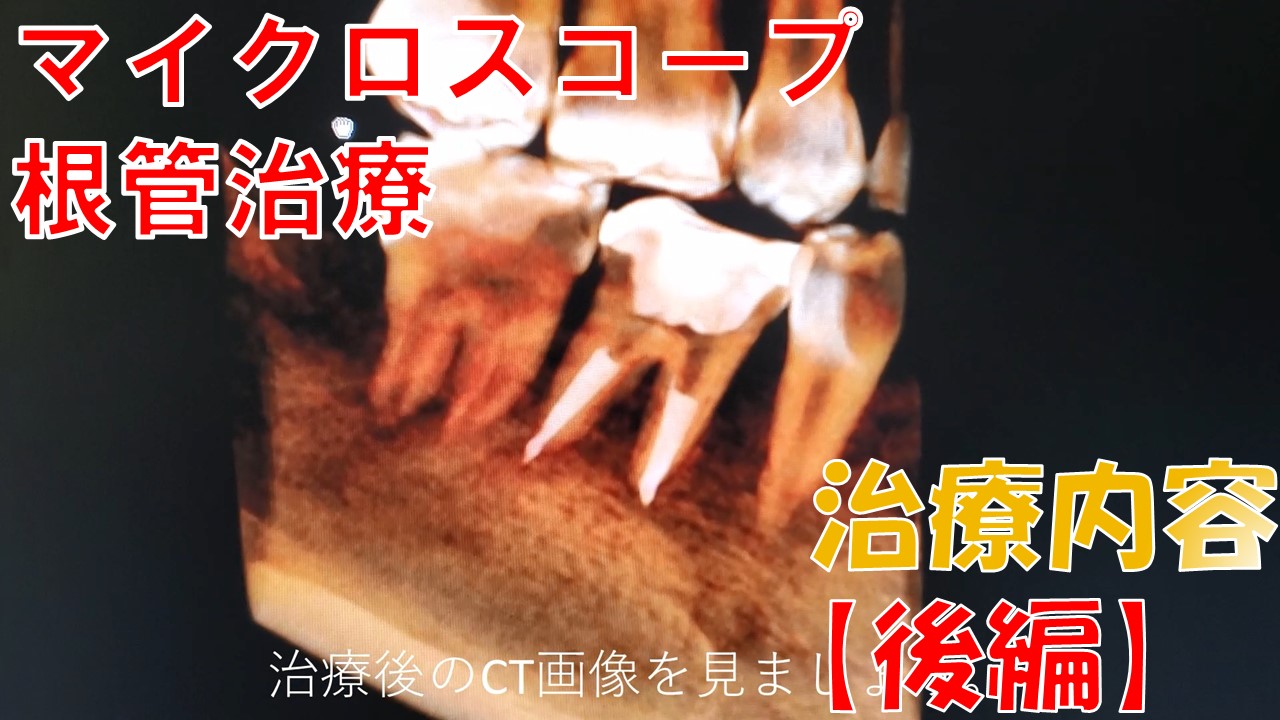 根管治療　マイクロスコープ　セカンドオピニオン