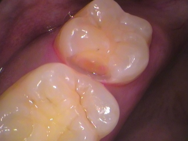 う蝕検知液で虫歯を染める