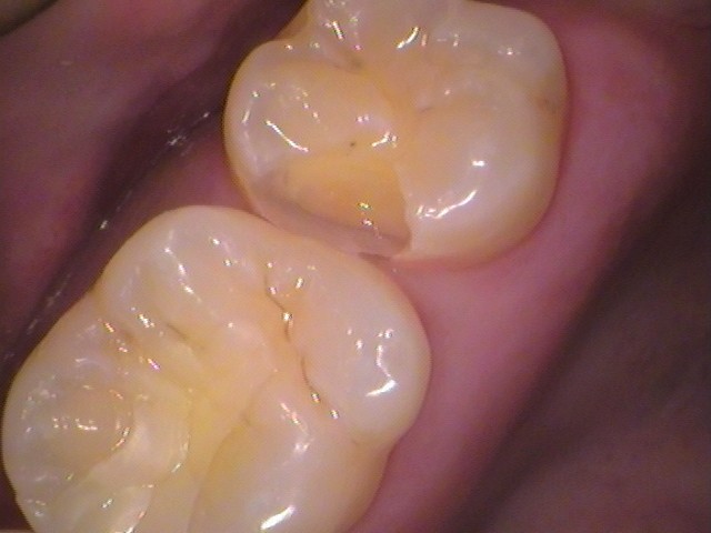 虫歯を取り除く