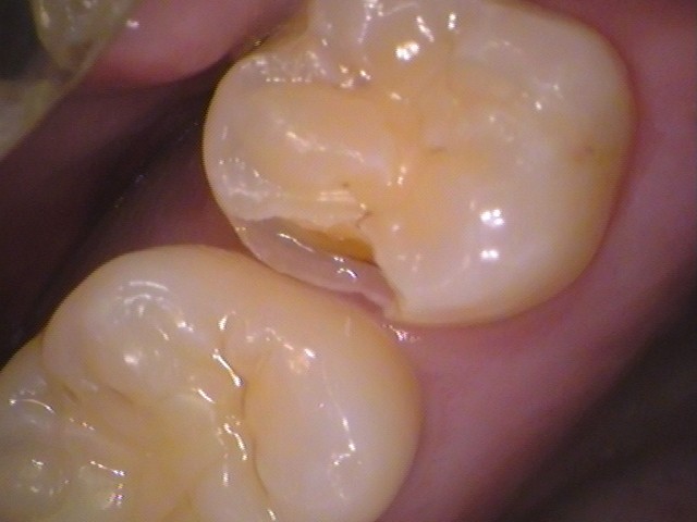 虫歯になっていないか確認