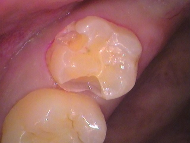 古い詰め物除去