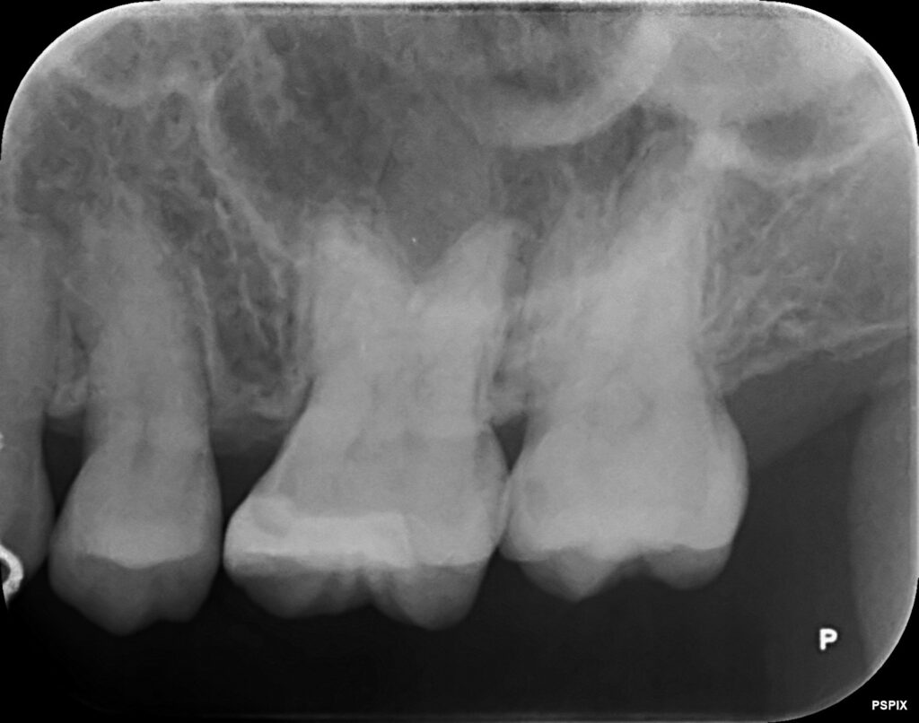 奥歯レントゲン写真