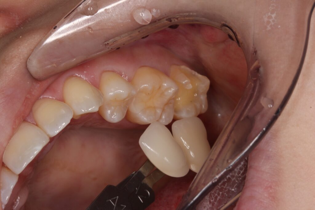 歯の色を写真で記録し