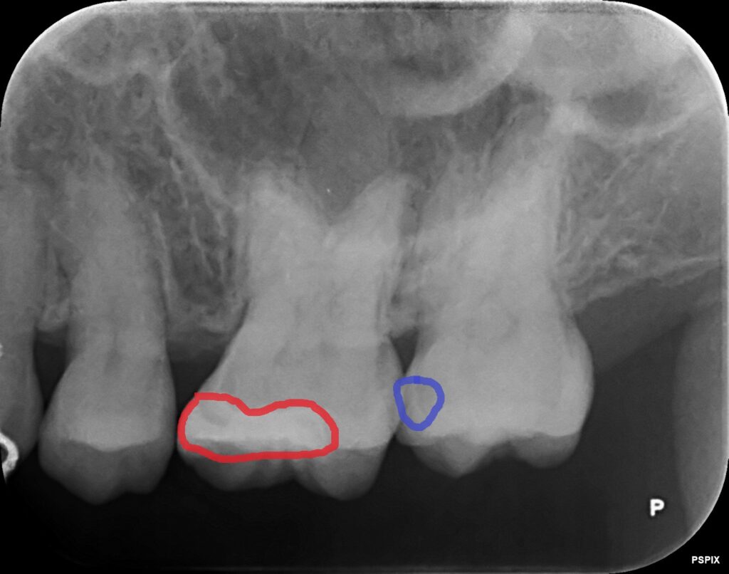 レントゲン写真虫歯