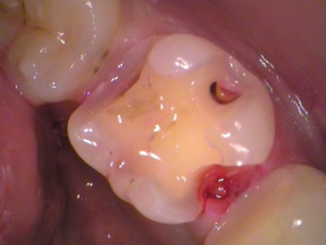 銀歯の中で虫歯