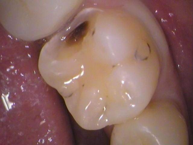 虫歯治療セラミックインレー