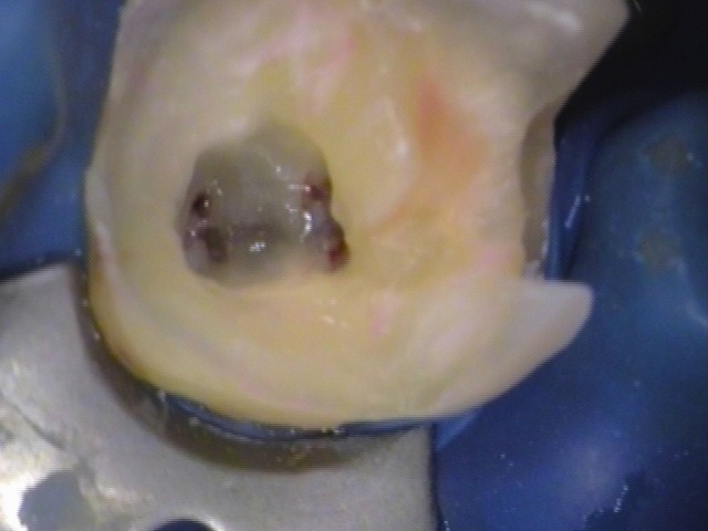 神経保存、神経を取らない、抜かない、MTA