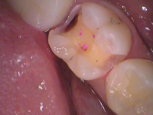 虫歯治療セラミックインレー