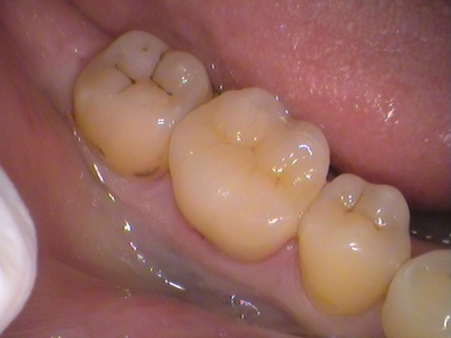 神経保存、神経を取らない、抜かない、MTA