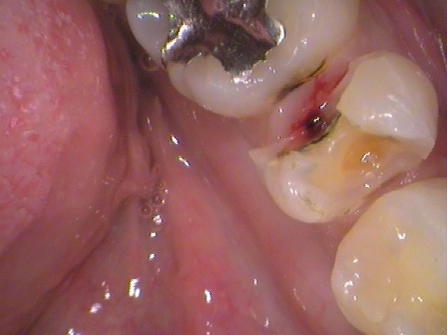 銀歯の中で虫歯