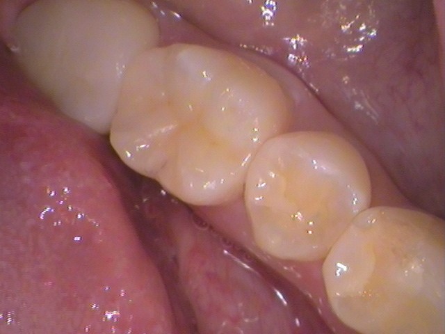 虫歯治療セラミックインレー