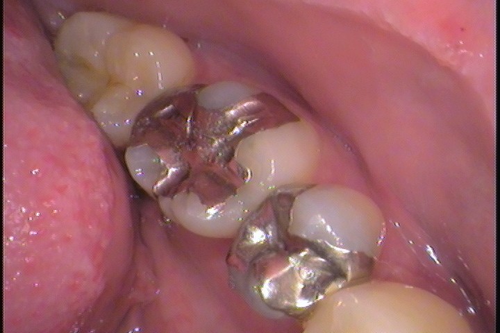 銀歯の中で虫歯